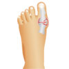 protecteur-hallux-valgus-deramed